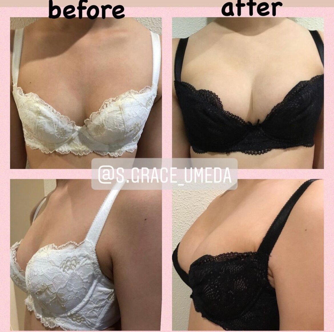 バストアップ施術before,after