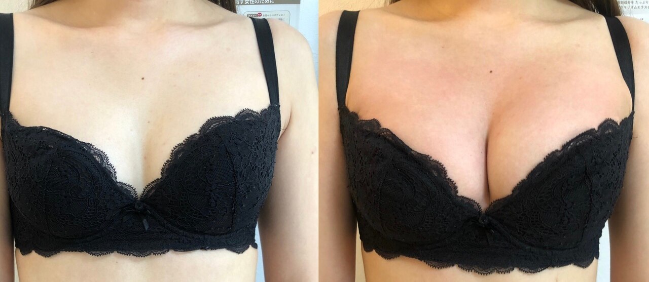 育乳バストアップbefore,after