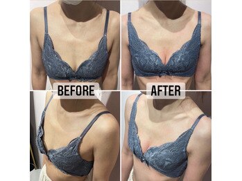 シンデレラバスト Before After
