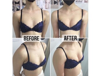 ☆シンデレラバスト☆beforeafter