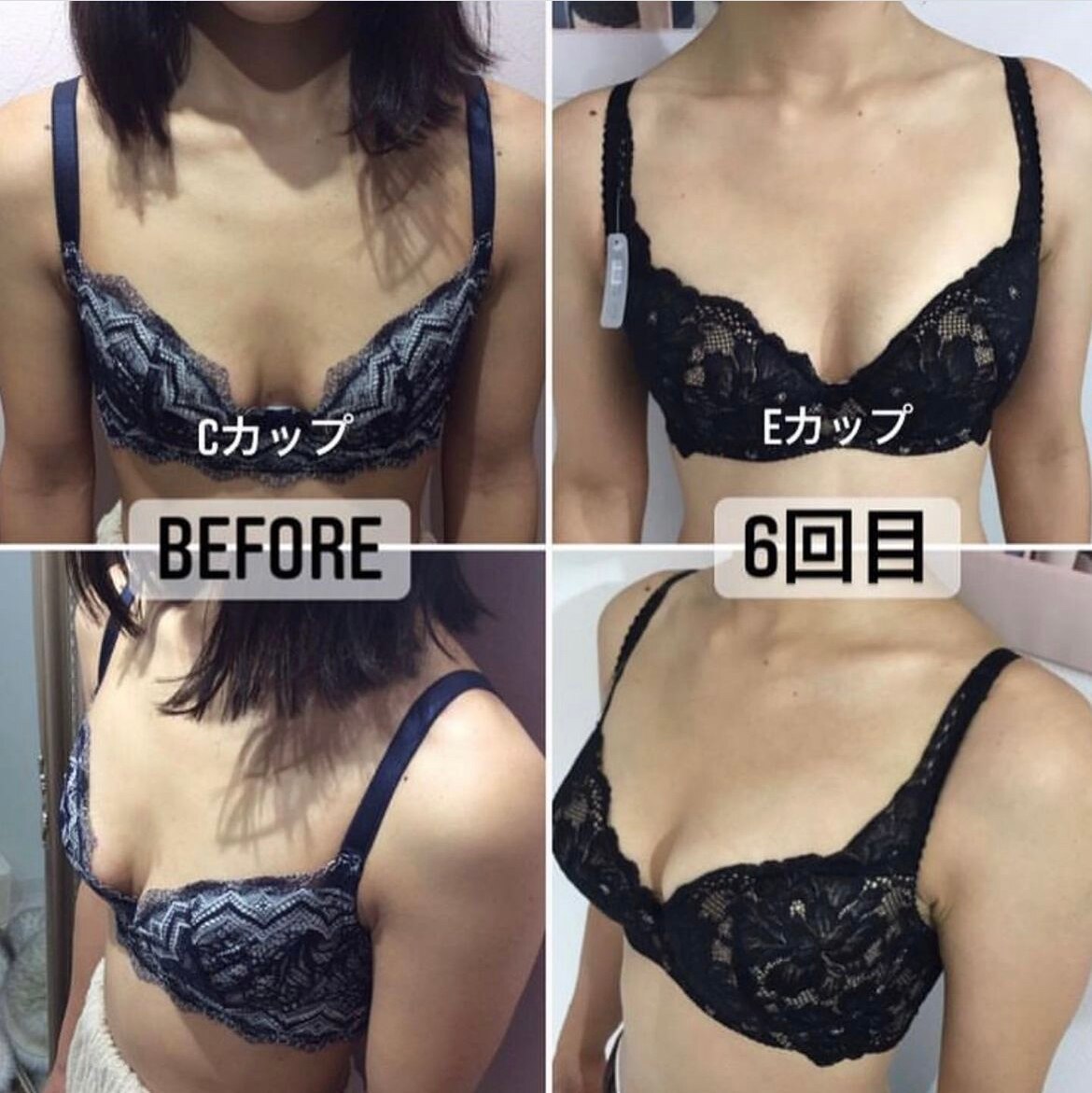 30代前半のお客様♪施術6回の #ビフォーアフター