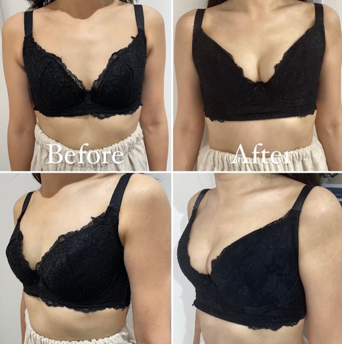 【梅田 バストケア】授乳後のバストも諦めなければ