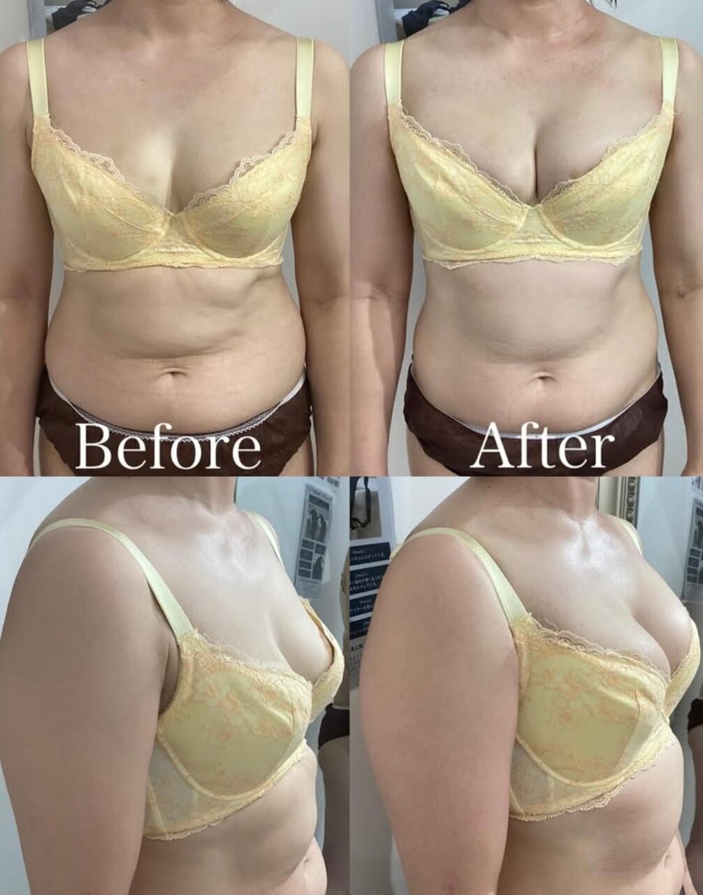 【梅田 バストケア】出産後のバストが復活!