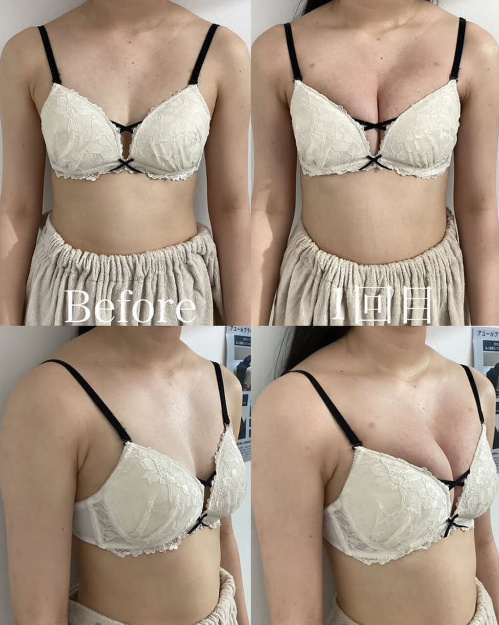 18歳学生さん 施術1回で爆乳に☆