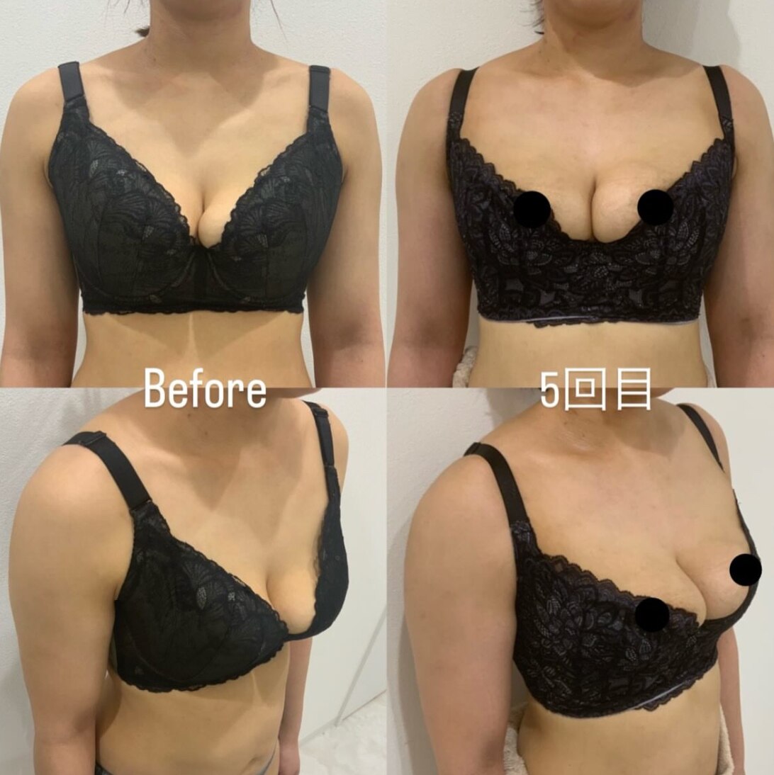 産後の萎んで削げたバストに悩む日々