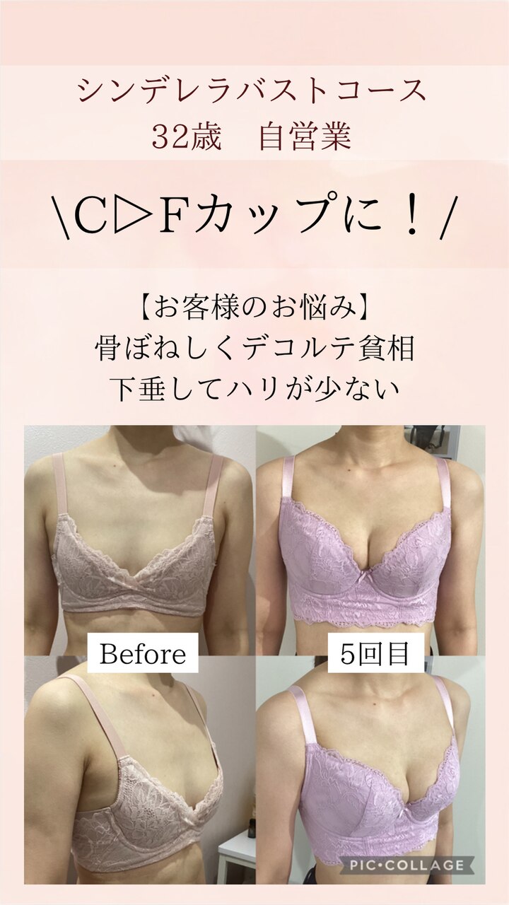 バストUPを諦めていた32歳のお客様3カップアップ!